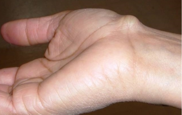 U nang hạch ở cổ tay là gì?