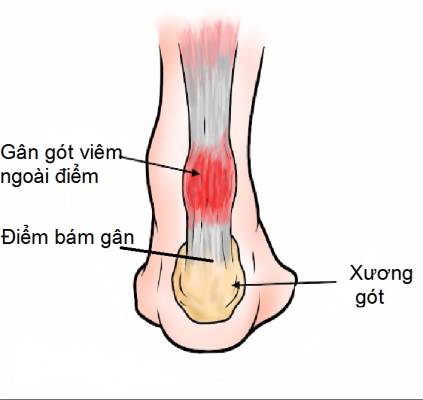 Viêm điểm bám gân đầu gối là vì sao?