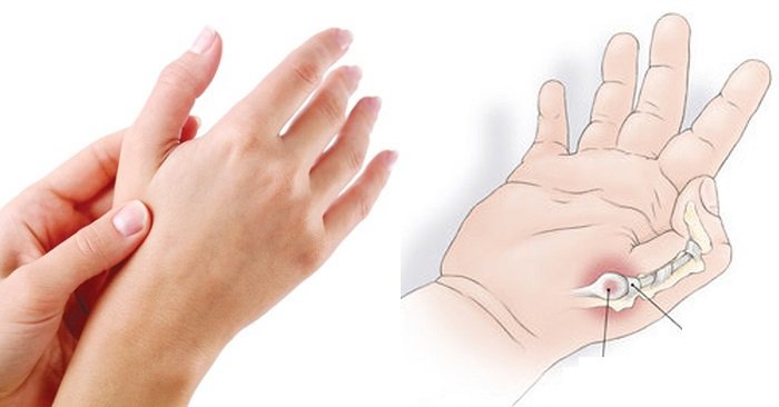 Viêm gân cổ tay sau sinh là gì?