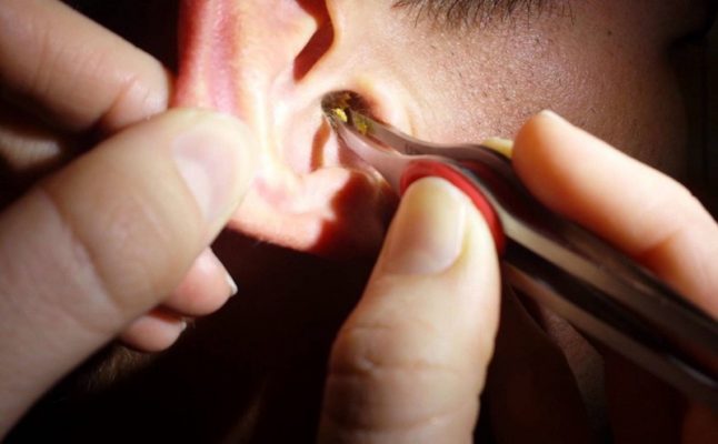 Làm sao khi lỗ tai bị bít?
