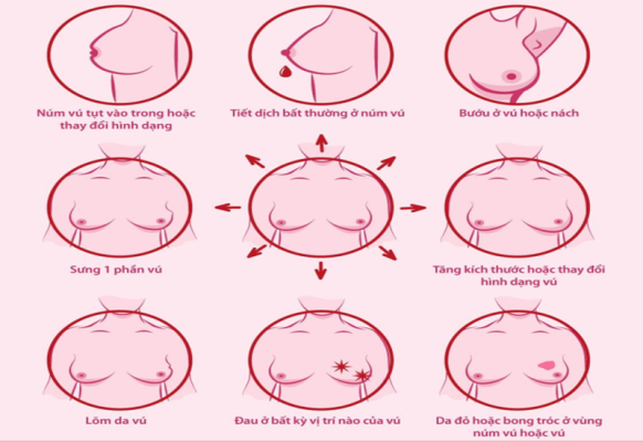 Cách kiểm tra ngực ung thư vú