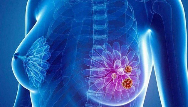 Ung thư vú giai đoạn 2 có chữa được không?